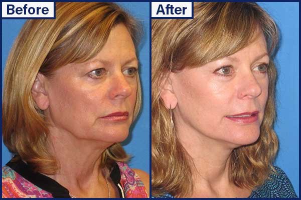before-and-after-10