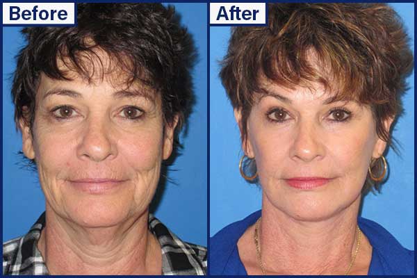 before-and-after-11