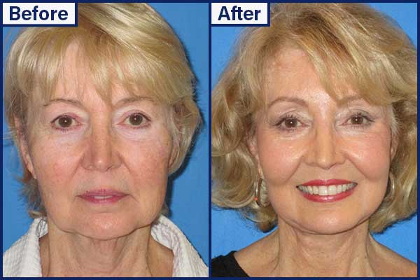 before-and-after-12