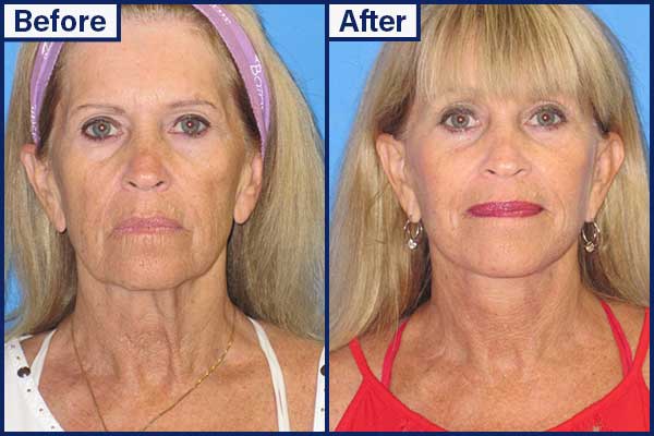 before-and-after-2