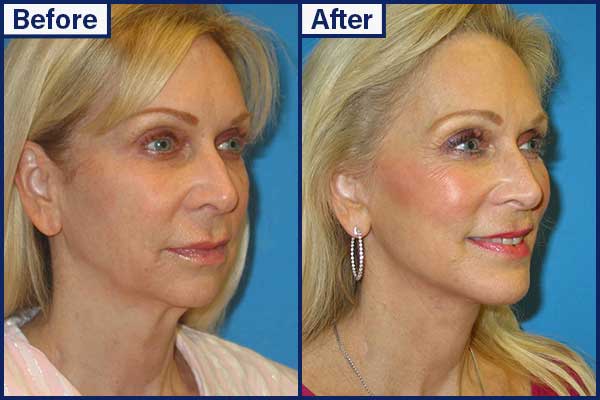 before-and-after-3