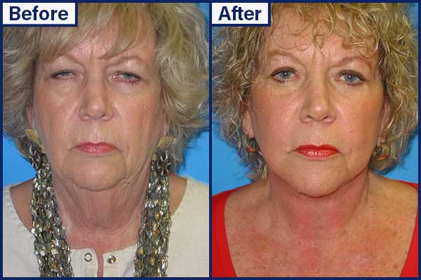before-and-after-4