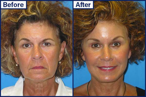 before-and-after-5