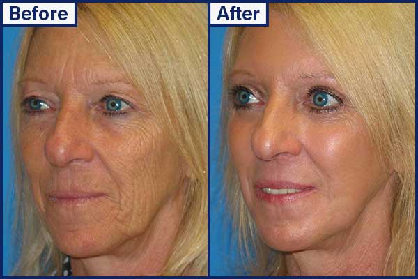 before-and-after-7