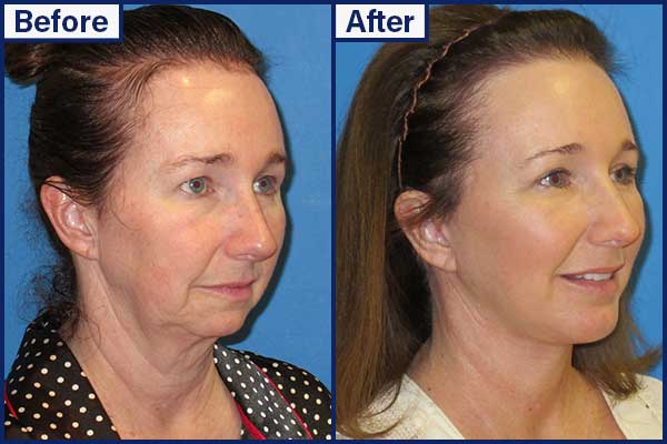 before-and-after-8