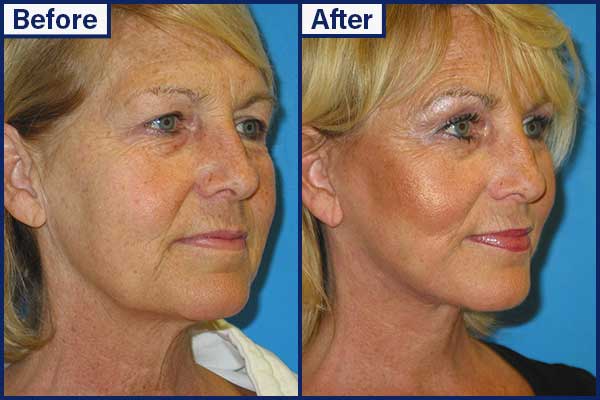 before-and-after-9