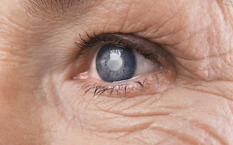 Image of eye with cataracts