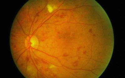Diabetic Retinopathy. You May Not Know You Have It.