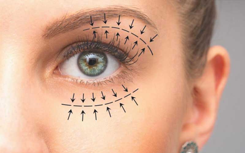 Advanced Bladeless Blepharoplasty for droopy eyelids