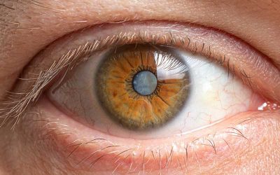 Options Available for Treatment of Cataracts