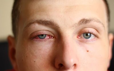 Understanding Pink Eye: Symptoms, Causes, and Treatment